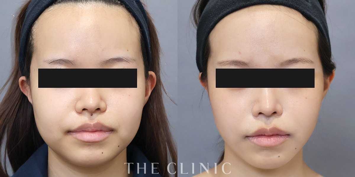 ベイザー脂肪吸引の術前／術後