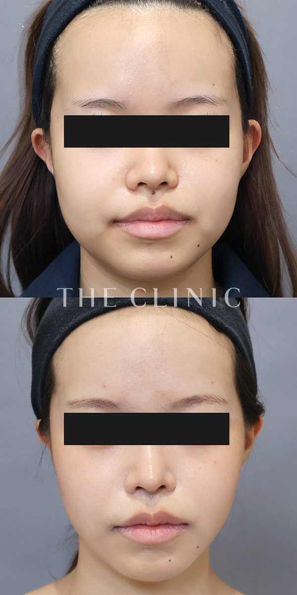 頰／顎のベイザー脂肪吸引（20歳女性）の術前・術後写真