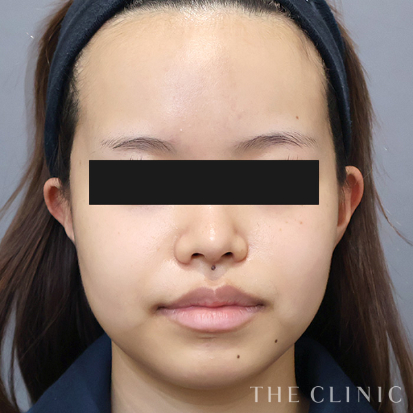 頰／顎のベイザー脂肪吸引（20歳女性）の術前写真