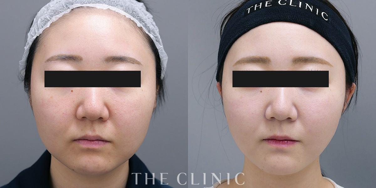 ベイザー脂肪吸引の術前／術後