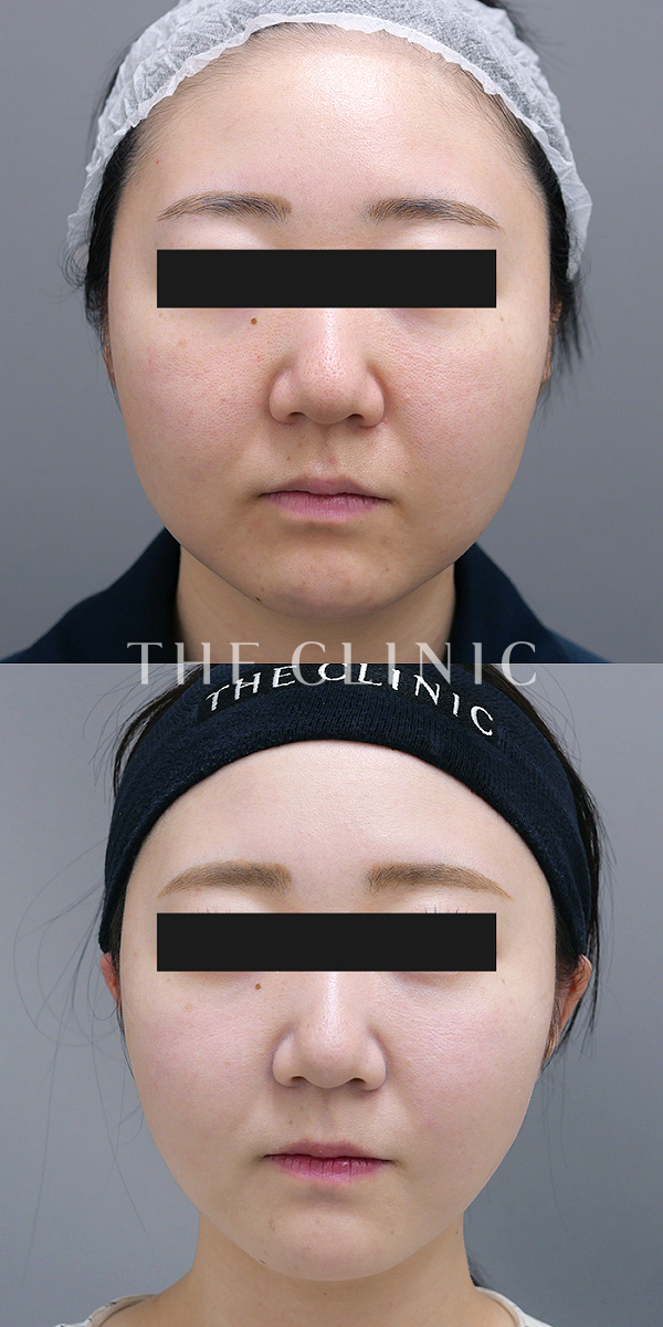 頰／顎のベイザー脂肪吸引（28歳女性）の術前・術後写真