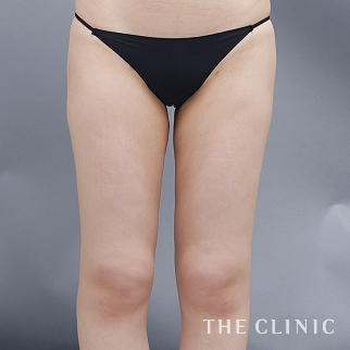 【THE CLINIC 症例画像】No.1527_2_太もも_ベイザー脂肪吸引