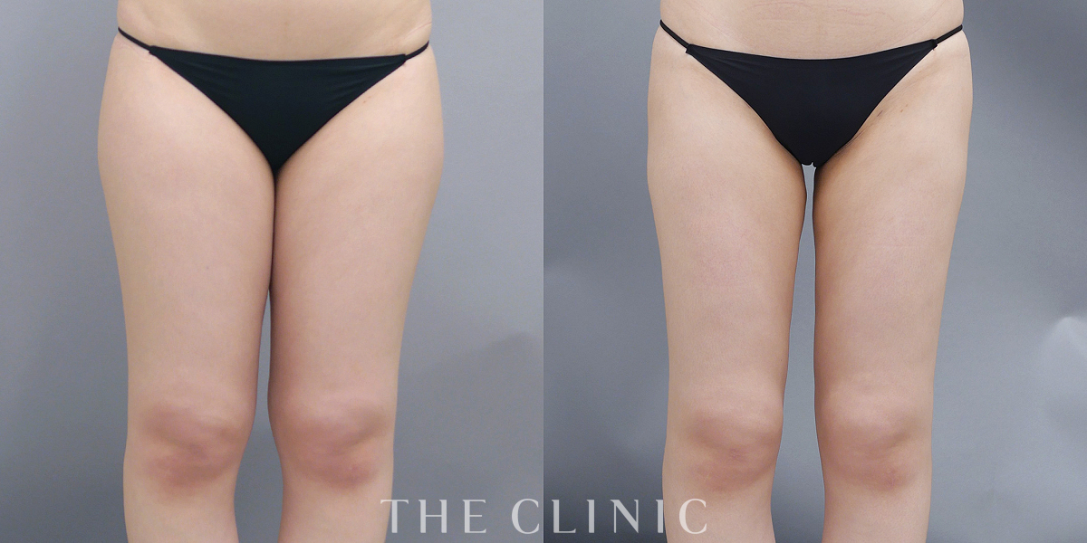 ベイザー脂肪吸引の術前/術後