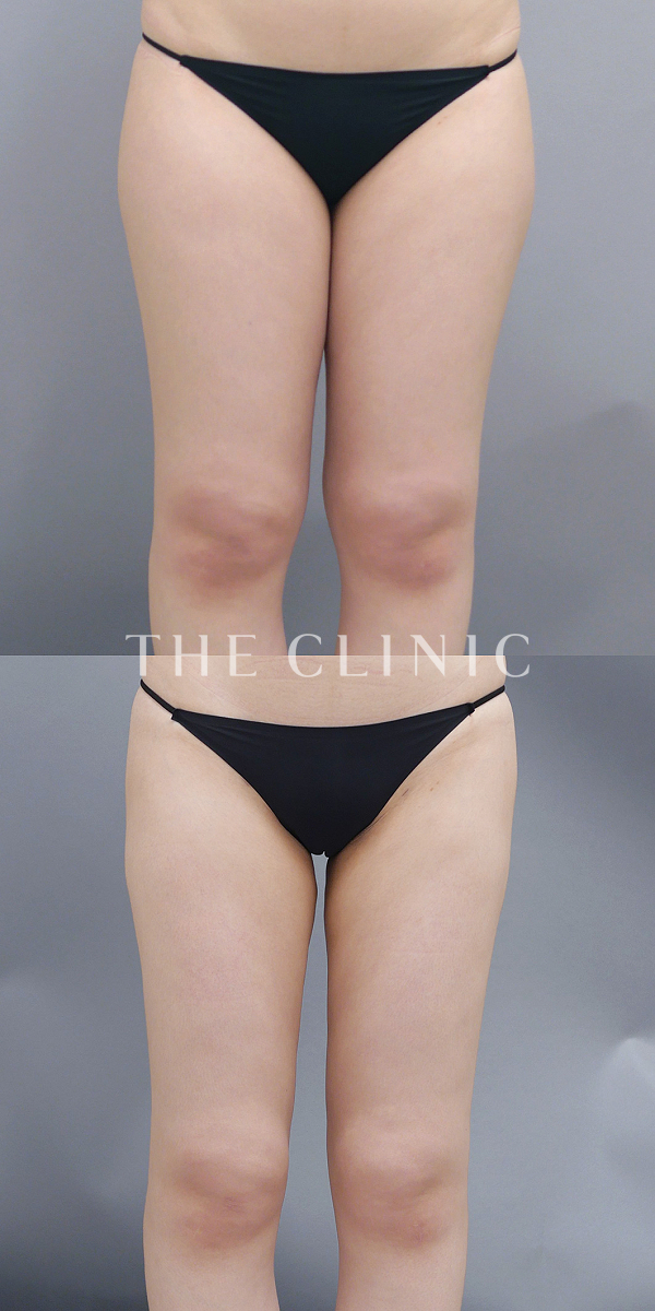 太もものベイザー脂肪吸引（24歳女性）の術前・術後写真