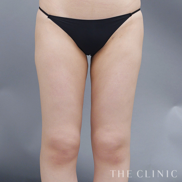 太もものベイザー脂肪吸引（24歳女性）の術後写真