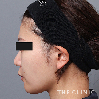 【THE CLINIC 症例画像】No.1528_1_おでこ(額)のくぼみ_コンデンスリッチフェイス(顔の脂肪注入)(執刀医:)