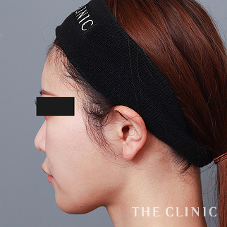 【THE CLINIC 症例画像】No.1528_2_おでこ(額)のくぼみ_コンデンスリッチフェイス(顔の脂肪注入)(執刀医：)