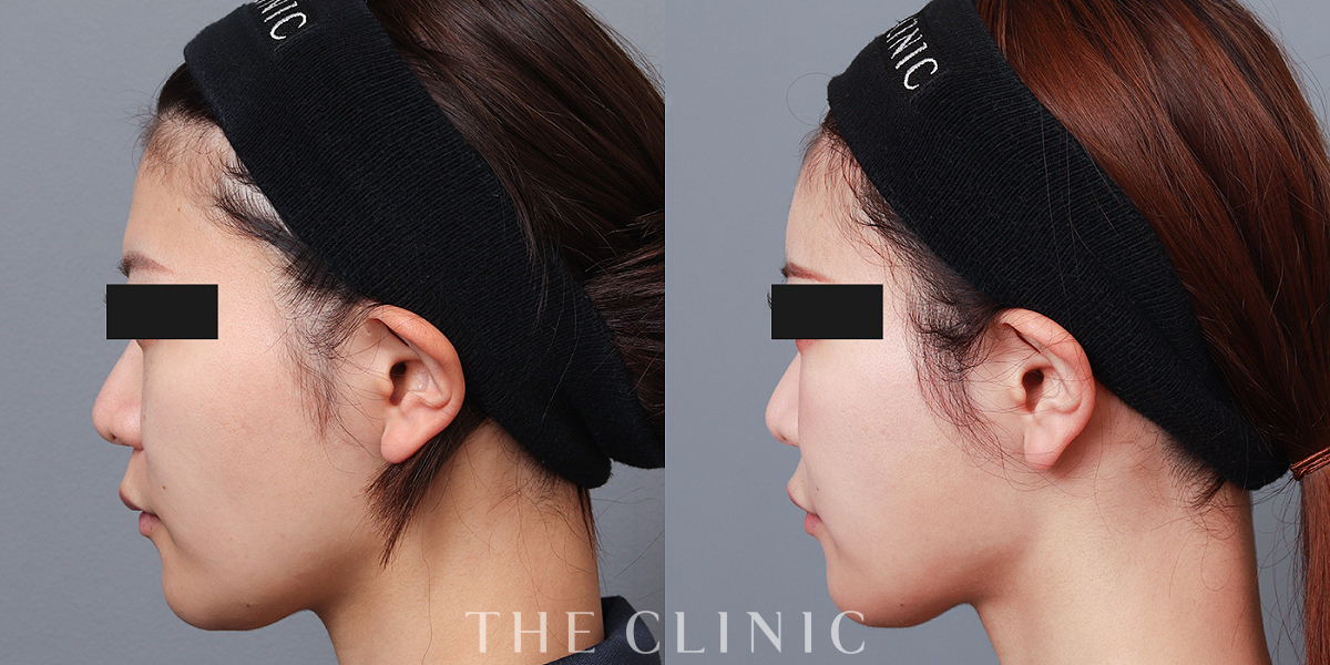 コンデンスリッチフェイス(顔の脂肪注入)の術前/術後