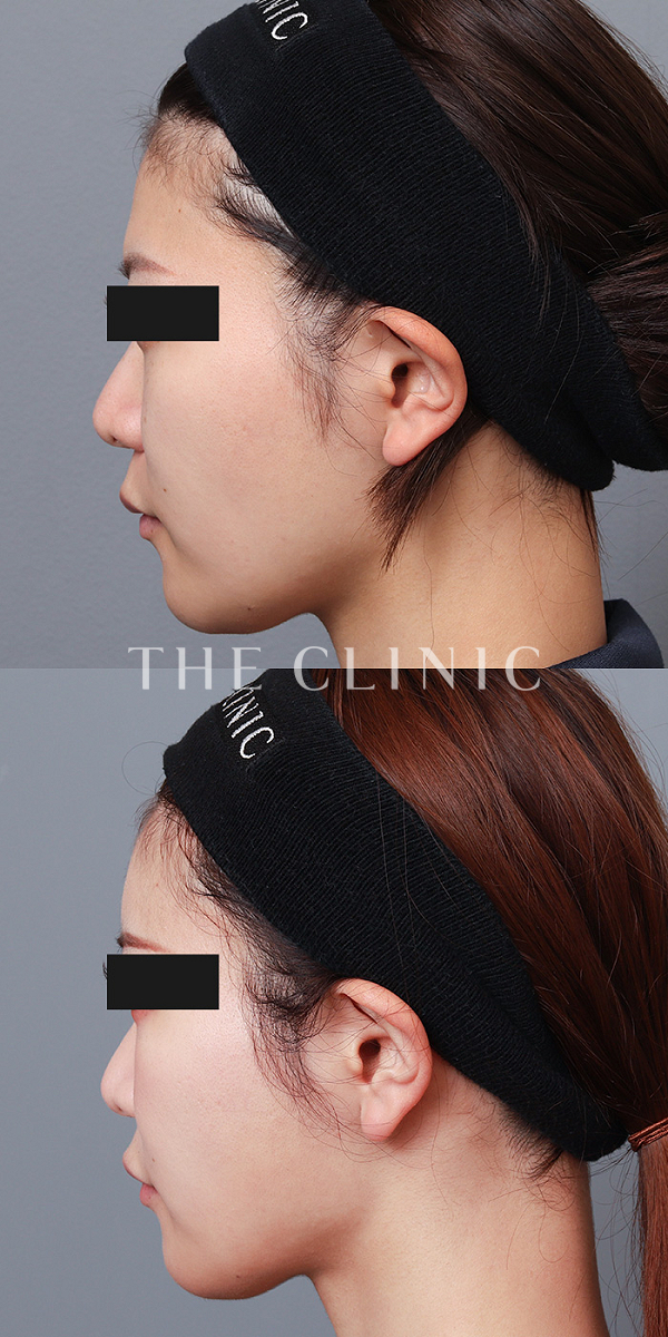 おでこ(額)のくぼみのコンデンスリッチフェイス(顔の脂肪注入)（29歳女性）の術前・術後写真