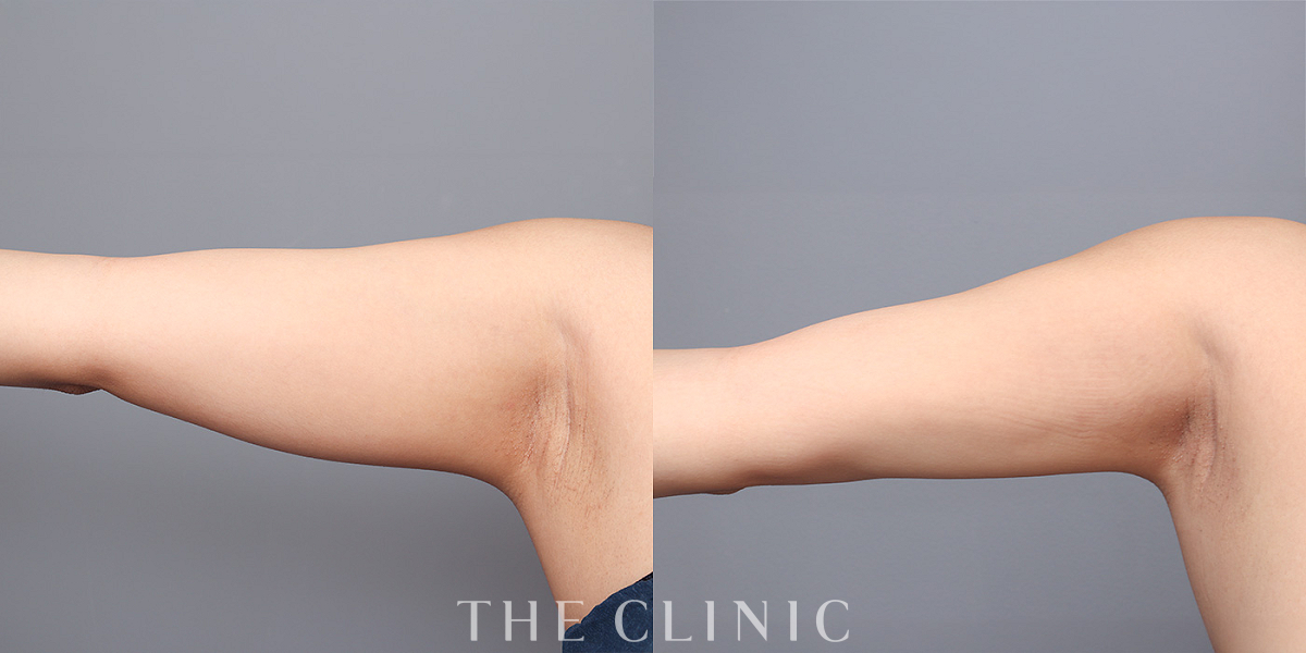 ベイザー脂肪吸引の術前／術後