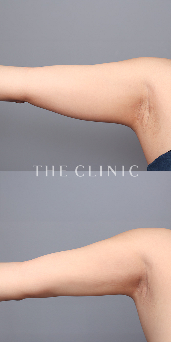 二の腕のベイザー脂肪吸引（29歳女性）の術前・術後写真