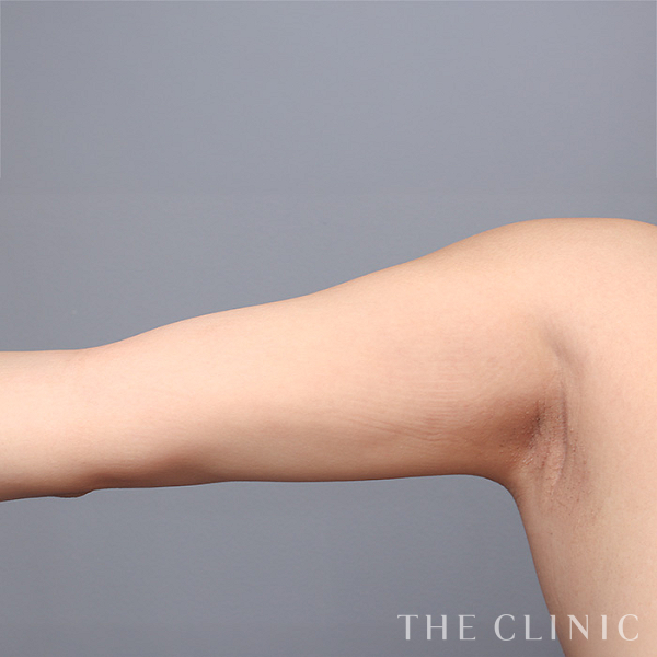 二の腕のベイザー脂肪吸引（29歳女性）の術後写真