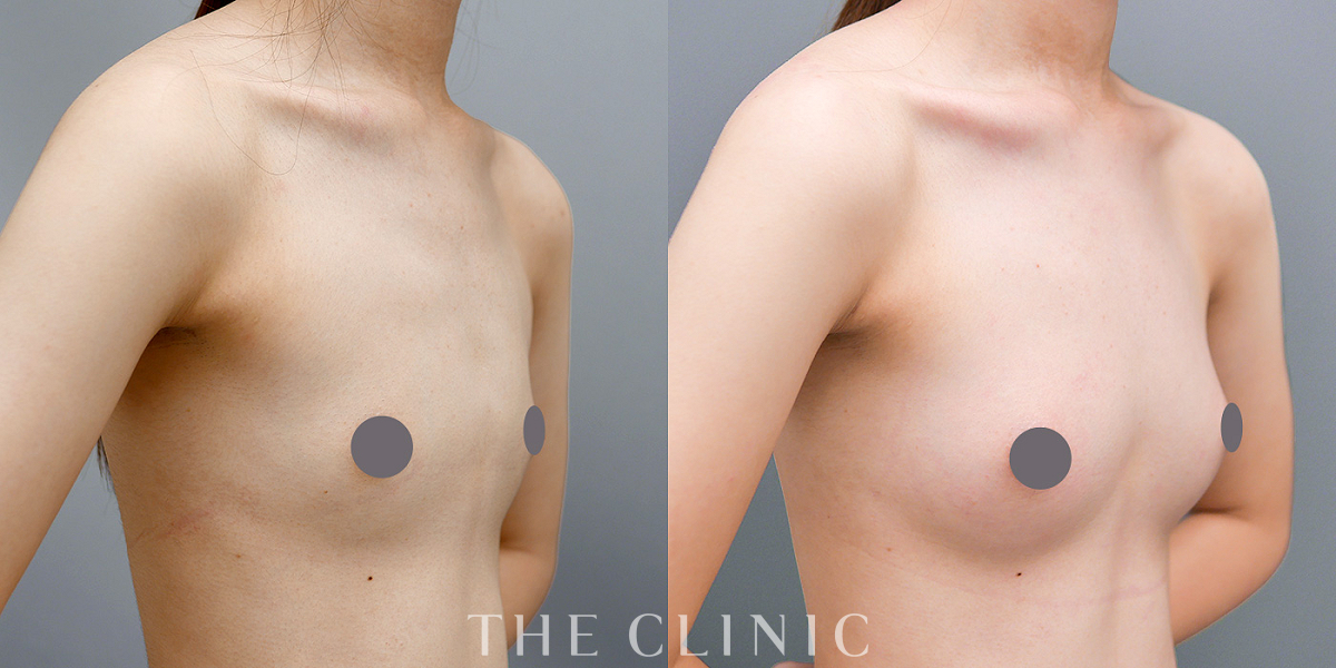 コンデンスリッチ豊胸の術前/術後