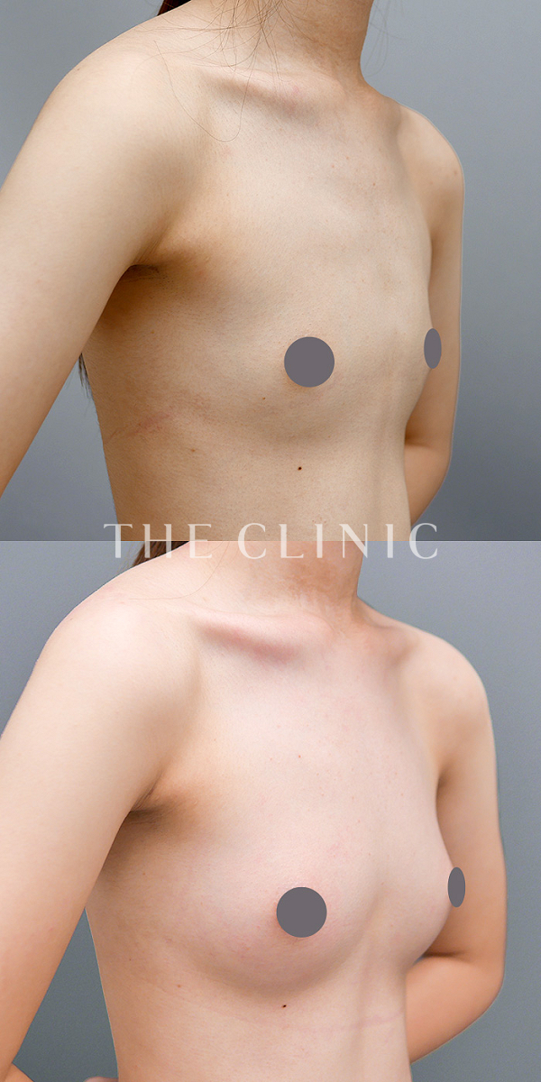 ボリュームアップのコンデンスリッチ豊胸（21歳女性）の術前・術後写真