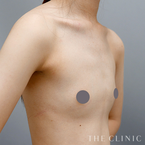 ボリュームアップのコンデンスリッチ豊胸（21歳女性）の術前写真