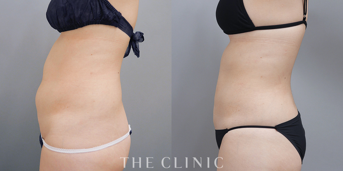 ベイザー脂肪吸引の術前/術後