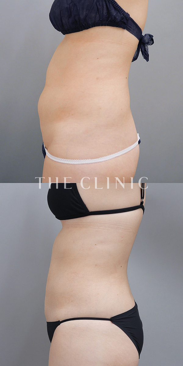腹部のベイザー脂肪吸引（34歳女性）の術前・術後写真