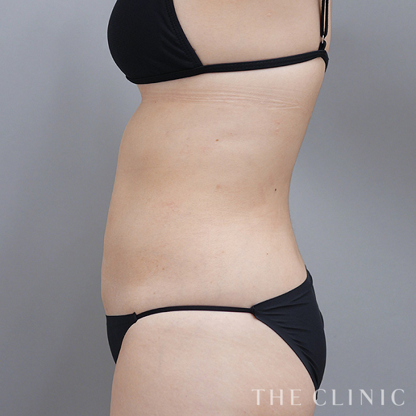 腹部のベイザー脂肪吸引（34歳女性）の術後写真