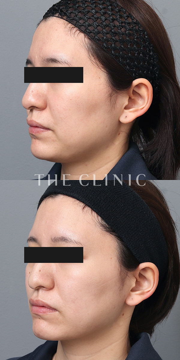 頰／顎のベイザー脂肪吸引（31歳女性）の術前・術後写真