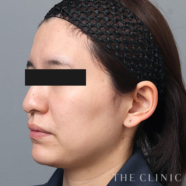 頰／顎のベイザー脂肪吸引（31歳女性）の術前写真