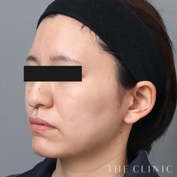 頰／顎のベイザー脂肪吸引（31歳女性）の術後写真