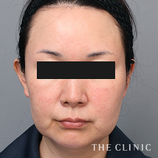 【THE CLINIC 症例画像】No.1533_1_頰/顎_マイクロCRF注入(顔の脂肪注入)(執刀医:今西 理也)
