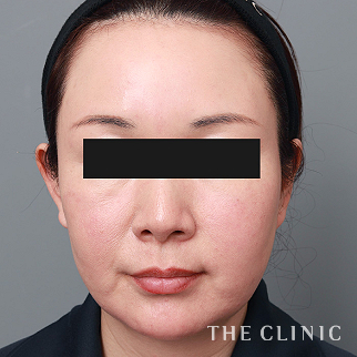 【THE CLINIC 症例画像】No.1533_2_頰/顎_マイクロCRF注入(顔の脂肪注入)(執刀医:今西 理也)