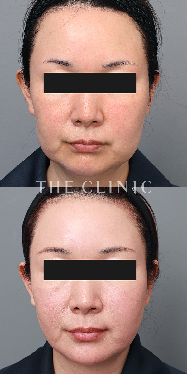 頰／顎・目尻のシワのマイクロCRF注入(顔の脂肪注入)（50歳女性）の術前・術後写真