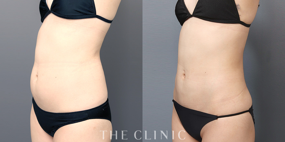 ベイザー脂肪吸引の術前/術後