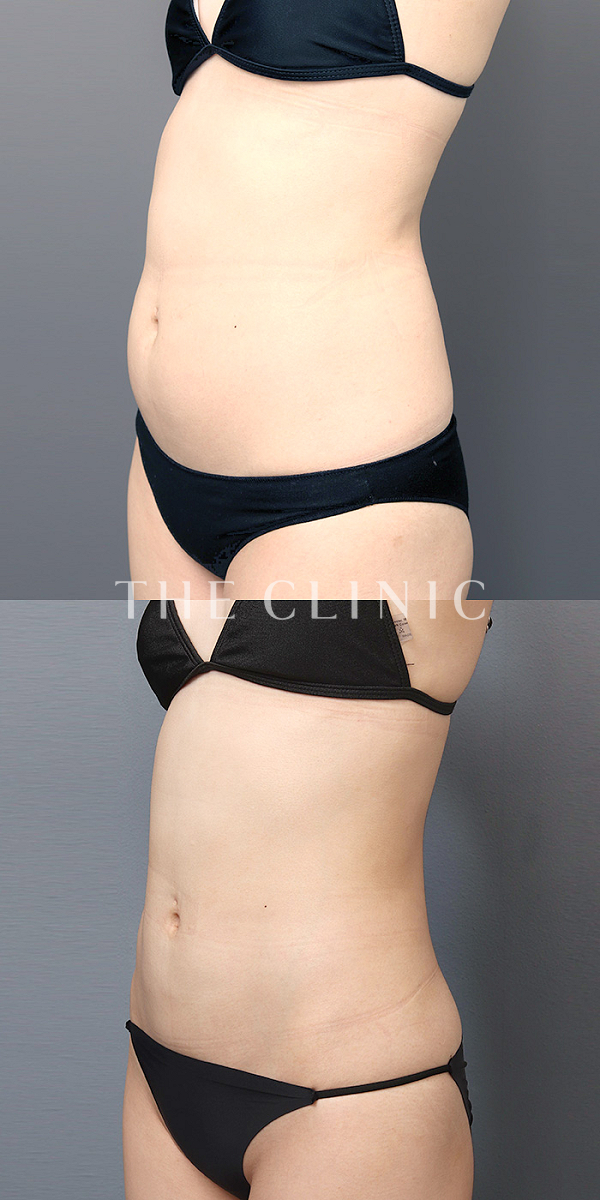 腰・ウエストのベイザー脂肪吸引（24歳女性）の術前・術後写真