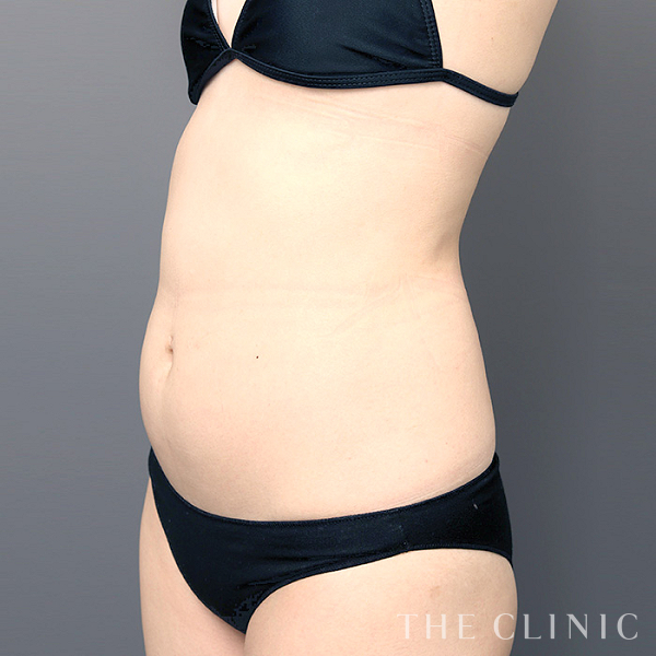 腰・ウエストのベイザー脂肪吸引（24歳女性）の術前写真