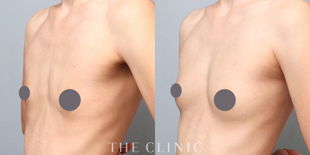 コンデンスリッチ豊胸の術前/術後