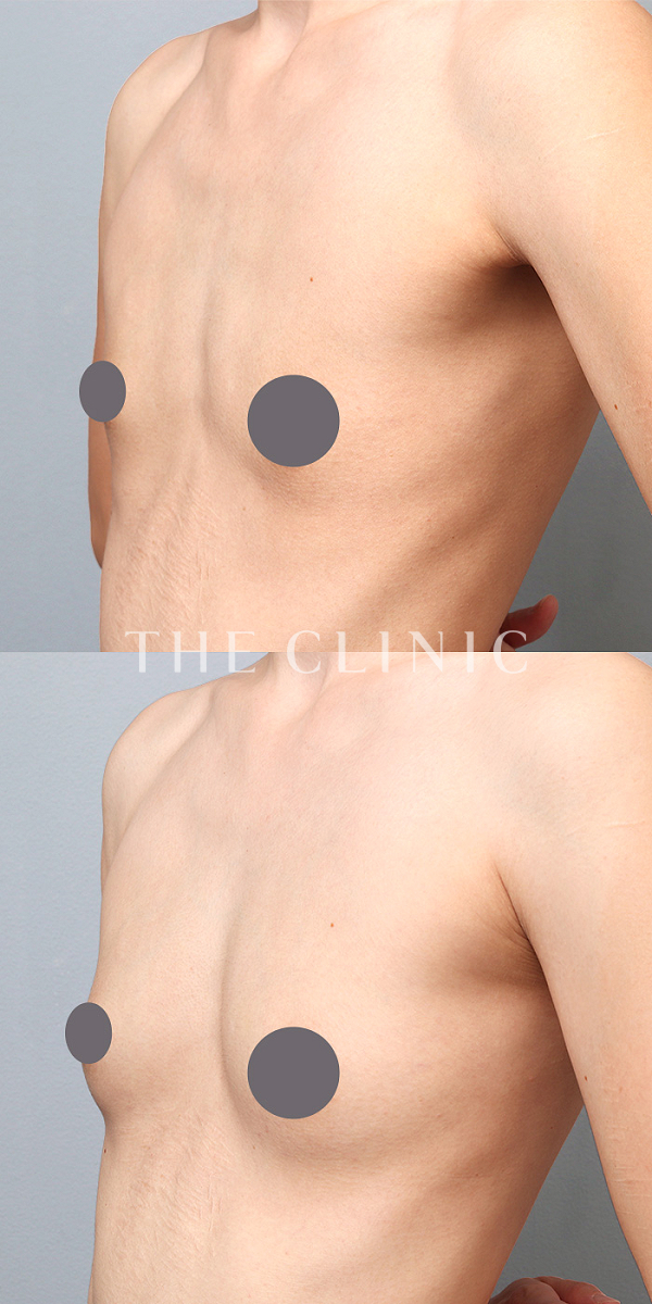 ボリュームアップのコンデンスリッチ豊胸（32歳女性）の術前・術後写真