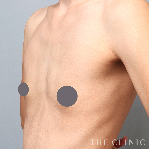 ボリュームアップのコンデンスリッチ豊胸（32歳女性）の術前写真