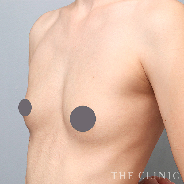 ボリュームアップのコンデンスリッチ豊胸（32歳女性）の術後写真