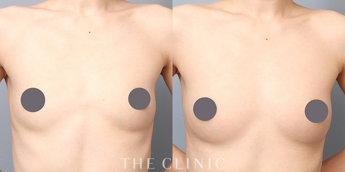 コンデンスリッチ豊胸の術前/術後