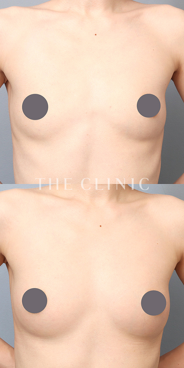 ボリュームアップのコンデンスリッチ豊胸（34歳女性）の術前・術後写真