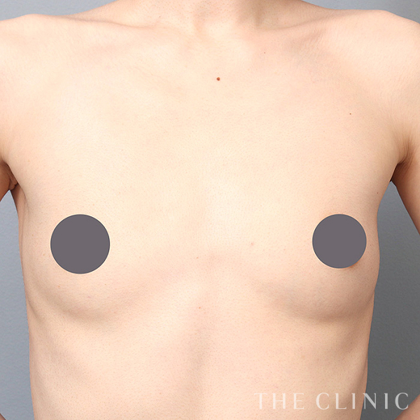 ボリュームアップのコンデンスリッチ豊胸（34歳女性）の術前写真