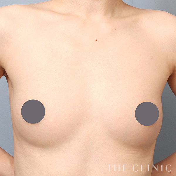 ボリュームアップのコンデンスリッチ豊胸（34歳女性）の術後写真