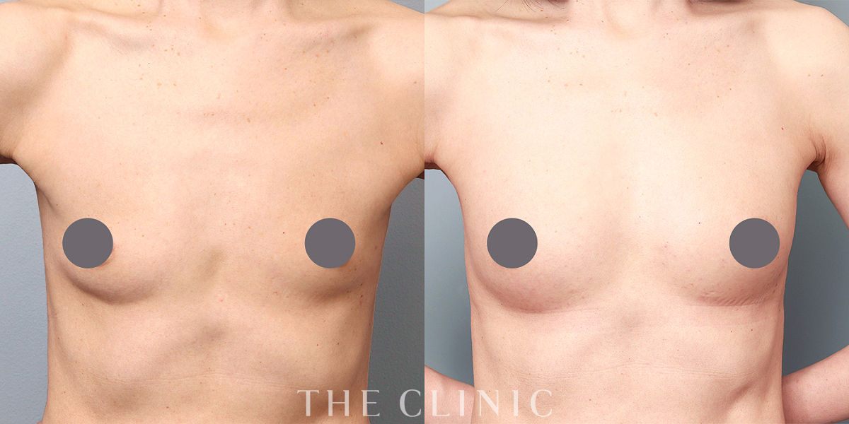 上向きバスト豊胸の術前/術後