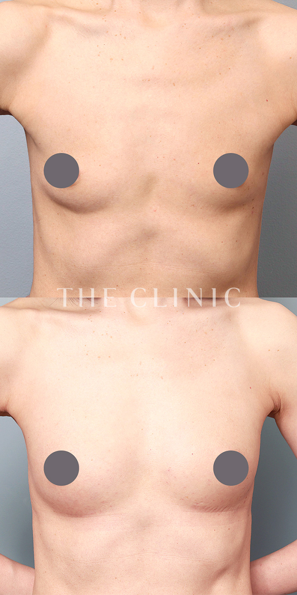 ボリュームアップの上向きバスト豊胸（52歳女性）の術前・術後写真