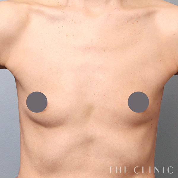 ボリュームアップの上向きバスト豊胸（52歳女性）の術前写真