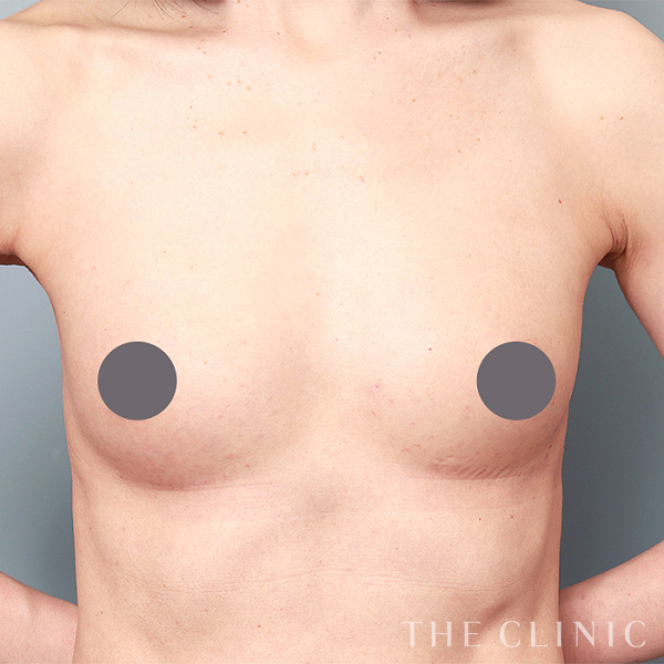 ボリュームアップの上向きバスト豊胸（52歳女性）の術後写真