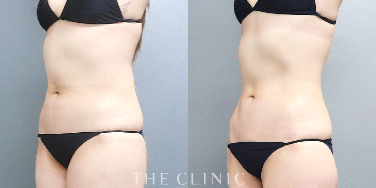 ベイザー脂肪吸引の術前/術後