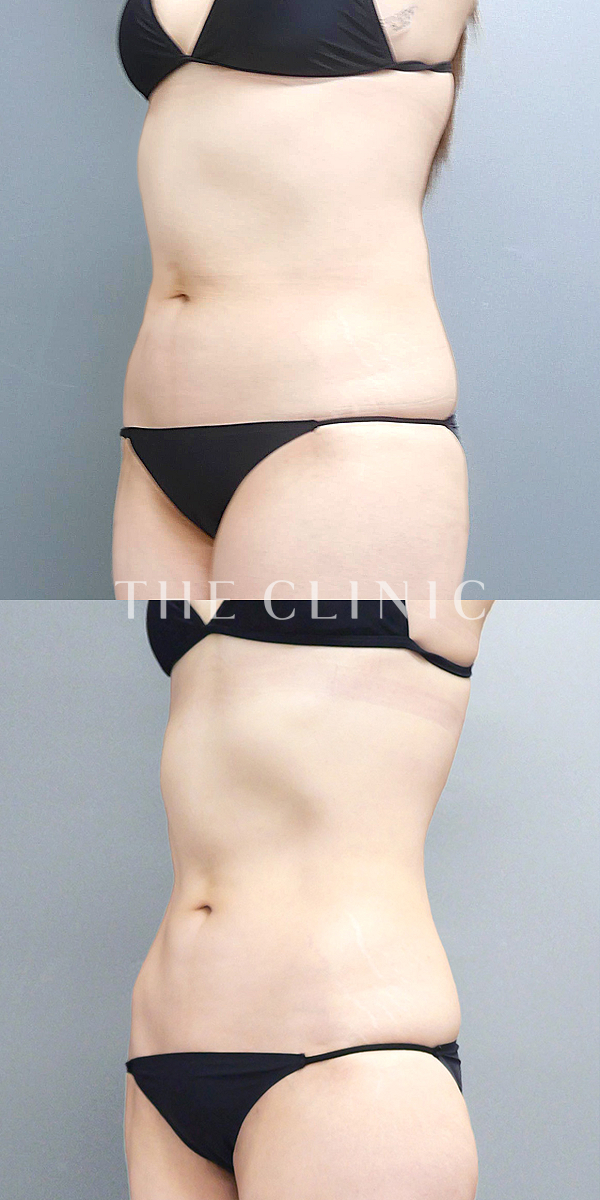 腹部のベイザー脂肪吸引（33歳女性）の術前・術後写真
