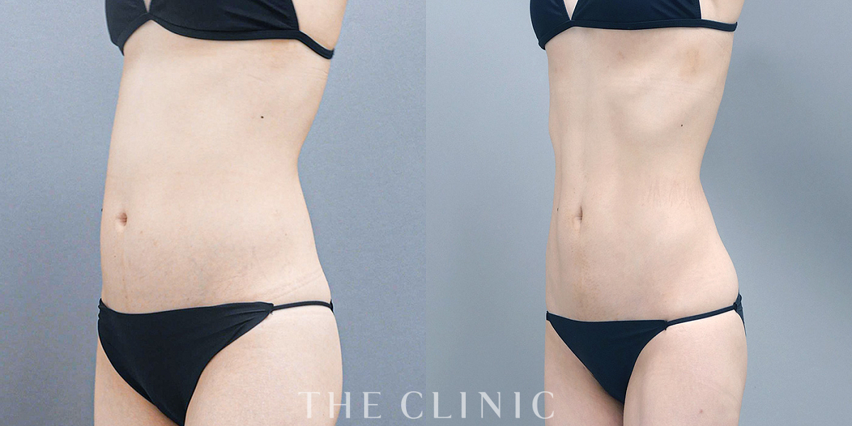 ベイザー脂肪吸引の術前/術後