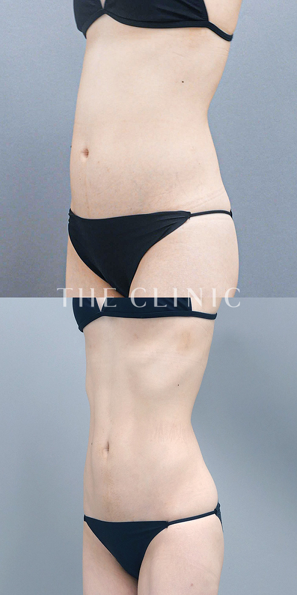 腹部のベイザー脂肪吸引（28歳女性）の術前・術後写真