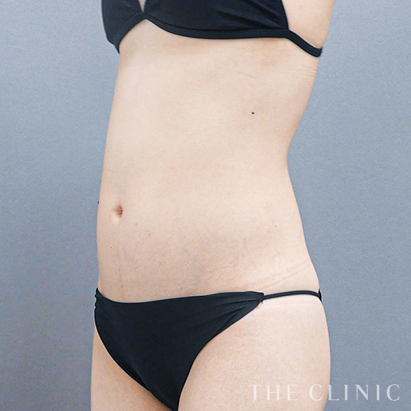 腹部のベイザー脂肪吸引（28歳女性）の術前写真