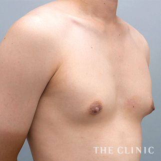 【THE CLINIC 症例画像】No.1540_1_真性女性化乳房_女性化乳房治療(男性の胸の膨らみ改善)(執刀医:木村 圭吾)