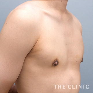 【THE CLINIC 症例画像】No.1540_2_真性女性化乳房_女性化乳房治療(男性の胸の膨らみ改善)(執刀医：木村 圭吾)